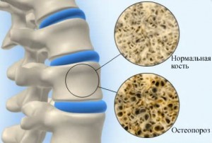 Остеопороз - симптоми, причини, терапевтичні методи лікування остеопорозу і лікування остеопорозу народними засобами, дієта при остеопорозі.