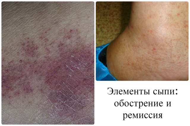Гемосидероз шкіри ніг, тіла: симптоми, лікування хвороби Шамберга у жінок і чоловіків