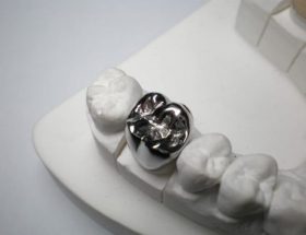 Коронки на зуби: різновиди протезів, їх плюси і мінуси, підготовка до установки, проведення процедури
