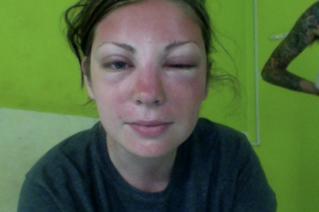 Як проявляється алергія на алкоголь і чому з'являються червоні плями на обличчі