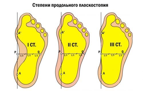 Порожня стопа: що це таке, симптоми і лікування, чи можлива служба в армії