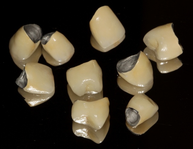 Коронки на зуби: які бувають, які краще, плюси і мінуси коронок