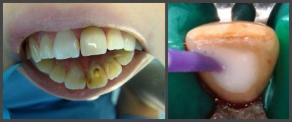 Ендоотбеліваніе зубів, внутрішньокоронкове відбілювання зуба: що це таке, препарати