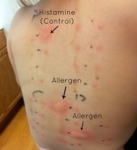 Негативний результат фадіатопа говорить про відсутність алергії?