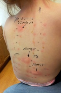 Негативний результат фадіатопа говорить про відсутність алергії?
