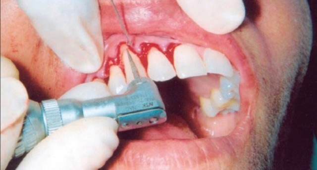 Карієс: види, симптоми, способи лікування карієсу, пломбування зубів при карієсі, профілактика карієсу