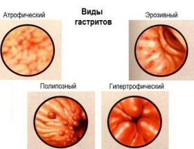 Гіпертрофічний гастрит шлунка: причини виникнення, супутні симптоми, дієта і принципи лікування