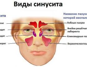 Пневматизація пазух носа: що це значить, причини і лікування