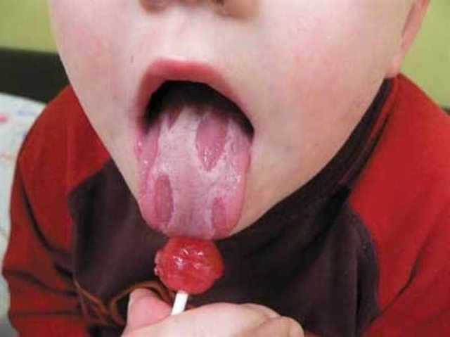 Глоссит: симптоми і лікування у дитини і дорослого, причини глоссита мови