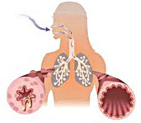 Бронхіальна астма: причини, симптоми, методи діагностики і лікування