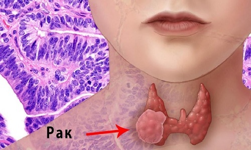 Папілярний рак щитовидки - причини, лікування і операція, прогноз