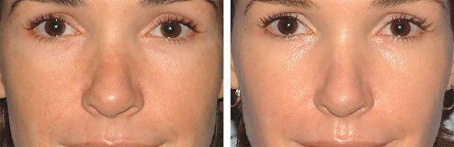 Лазерний пілінг обличчя: що це таке, протипоказання, фото до і після