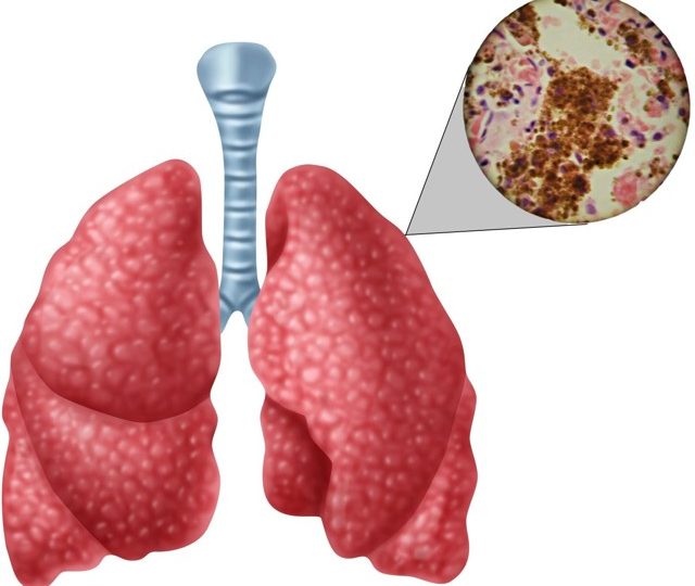Як правильно приймати Беклометазон при бронхіальній астмі: інструкція із застосування препарату