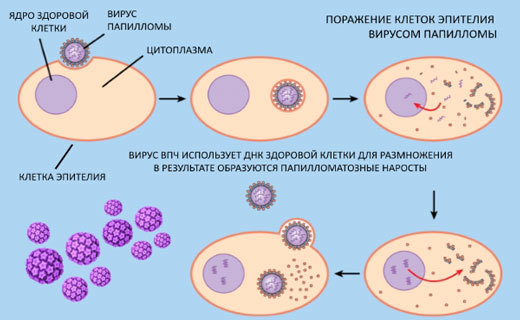 Папіломатоз гортані: причини, симптоми і лікування