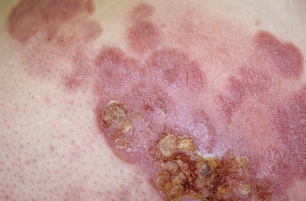 Лімфоцітома шкіри: фактори ризику розвитку, типові симптоми, методи лікування та прогноз