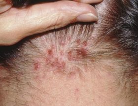 Прищі на голові в волоссі у чоловіка: причини виникнення та ефективні методи лікування, фото патології