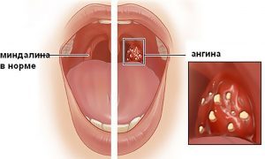 Гнійна ангіна у дітей: симптоми і лікування в домашніх умовах