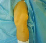 Вивих колінного суглоба: симптоми і лікування, причини, види патології