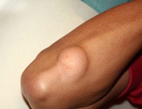 Лейоміосаркома шкіри: причини виникнення, типові ознаки, принципи лікування та прогноз