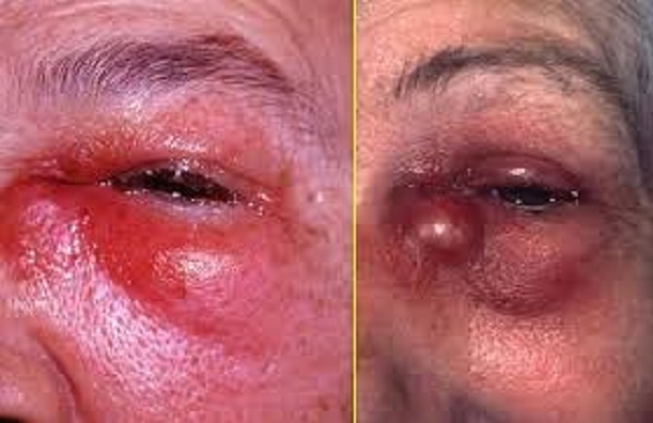 Флегмона очі - причини, симптоми флегмони очниці, століття, слізного мішка, діагностика і лікування