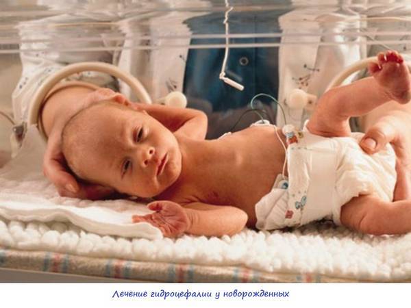 Гідроцефалія (водянка головного мозку) у новонароджених - симптоми, ознаки, причини, методи лікування та профілактики.
