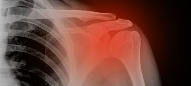 Відкритий перелом плечової кістки зі зміщенням та без: перша допомога, ознаки