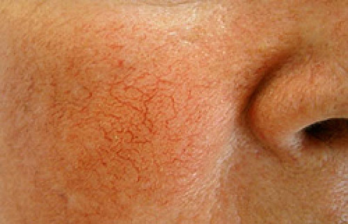 Дуже чутлива шкіра: причини і правила догляду за чутливою шкірою