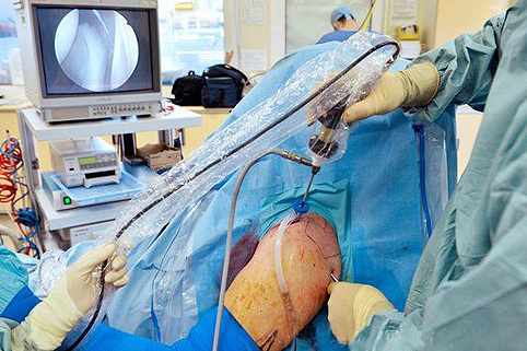 Артроскопія суставов- операція, підготовка, відновлення після артроскопії