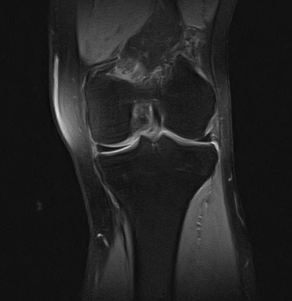 МРТ колінного суглоба: що показує, як проходить, плюси і мінуси