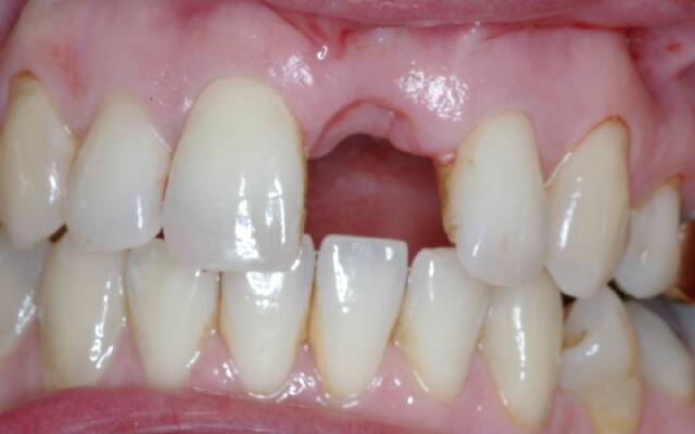 Лікування після видалення зуба: чим полоскати для швидкого загоєння
