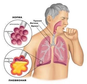Гостра пневмонія - симптоми, лікування та можливі ускладнення
