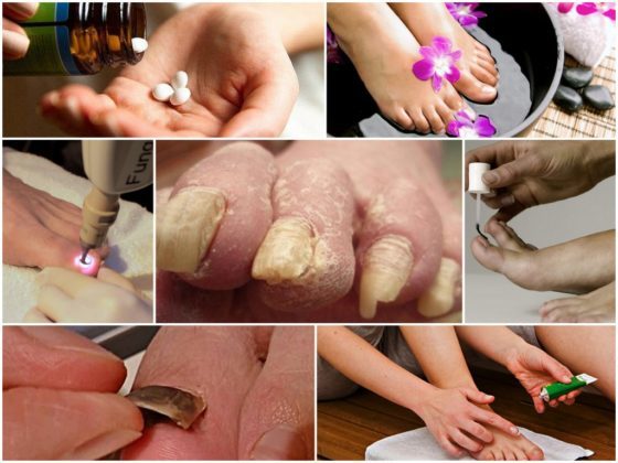 Лікування запущеного грибка нігтів: ефективні засоби лікування грибка нігтів запущеної форми