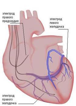 Серцева недостатність: стадії, функціональні класи, ступеня, форми