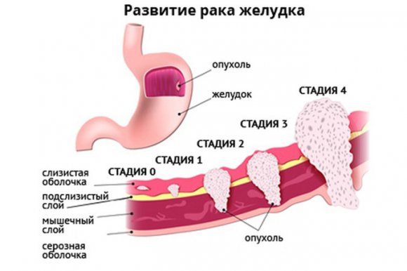 Лейоміома шлунка: що це таке, симптоми і лікування, профілактика