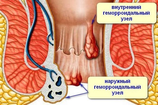 Засоби від зовнішнього геморою, свічки при зовнішньому геморої, лікування гемороїдальних вузлів