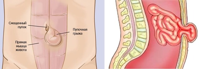 Хворобливе ущільнення в животі у жінок: можливі причини і методи діагностики 