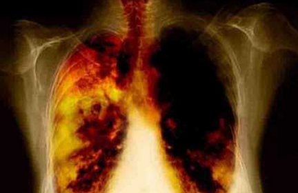 Рак легенів: відсоток виживання, термін життя при різних стадіях, діагностика