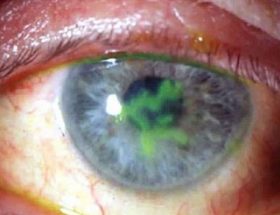 Кератит очі: що це таке, симптоми і лікування захворювання з докладними фото