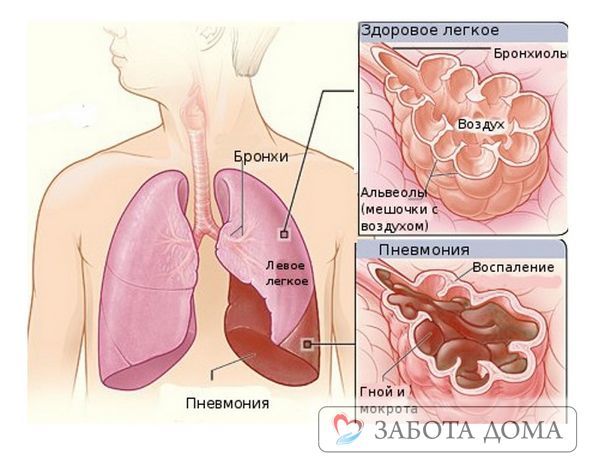 Смерть від пневмонії - причини летального результату при запаленні легенів