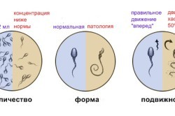 Кріптоспермія: провокуючі фактори, характерні ознаки, діагностика та особливості лікування