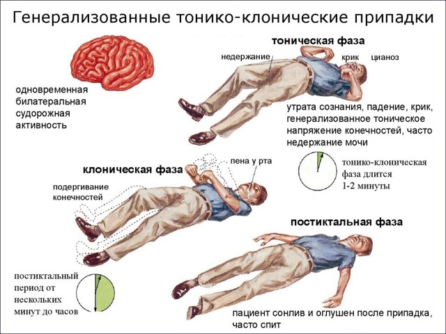 Синдром веста видео приступа