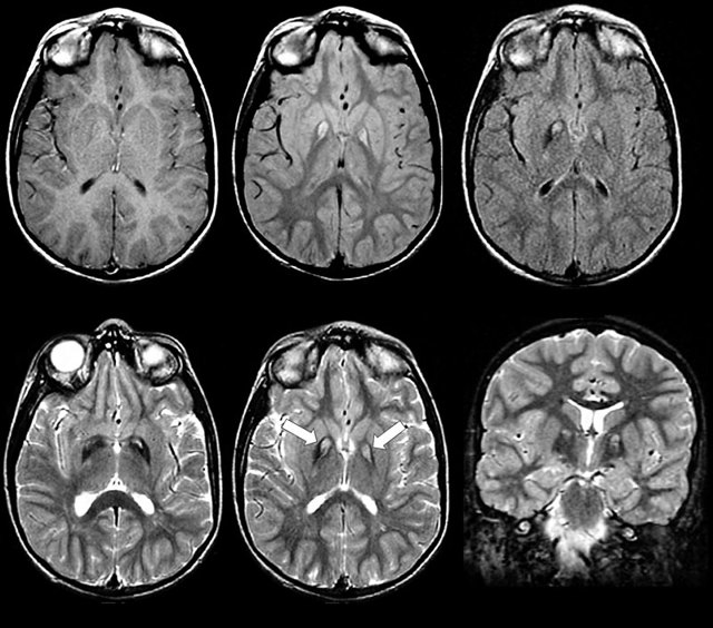 МРТ голови: що показує і як роблять МРТ голови і судин головного мозку
