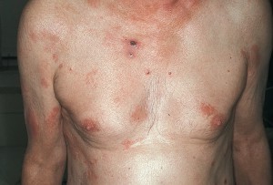 Лімфоцітома шкіри: що це таке, симптоми і лікування у дітей та дорослих