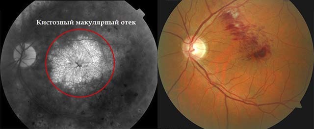 Макулярної набряк очі: види (діабетичний, дифузний, кістозний), причини і лікування