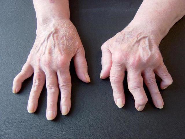 Болять пальці рук: можливі захворювання, клінічна картина, діагностика і принципи лікування
