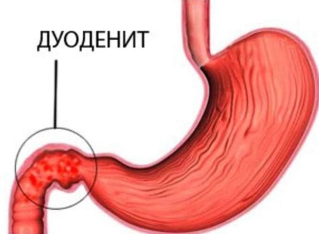 Відрижка - причини відрижки після їжі, відрижки тухлими яйцями, відрижки повітрям