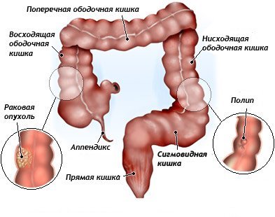 Доброякісні пухлини товстого кишечника: механізм розвитку, супутні симптоми, методи обстеження та лікування