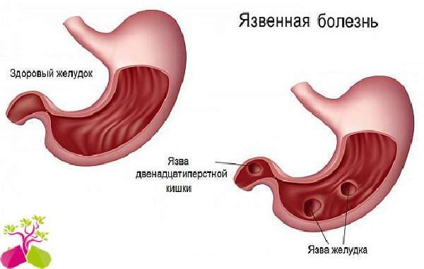 Біль в шлунку: причини виникнення, діагностика, характер болю в шлунку і методи лікування