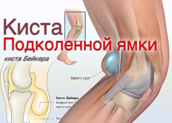 Болить коліно при ходьбі, в районі чашечки, під нею: причини, ніж лікувати