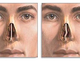 Викривлення носової перегородки: причини і лікування операцією і без